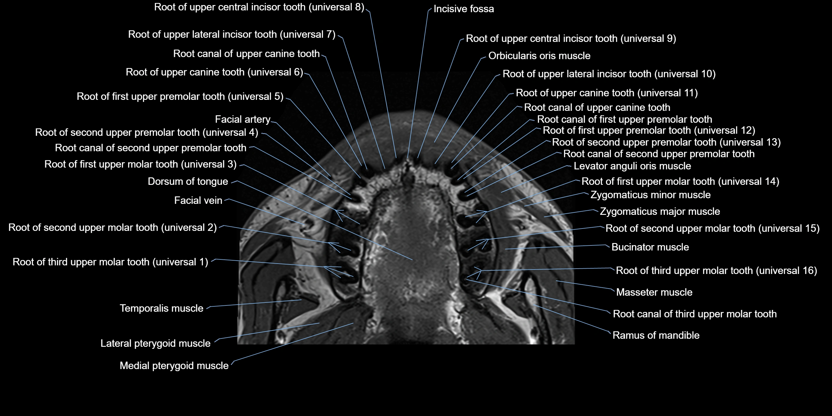 Dental MRI( tooth) axial labelled  cross sectional 3T anatomy -img-00001.webp
